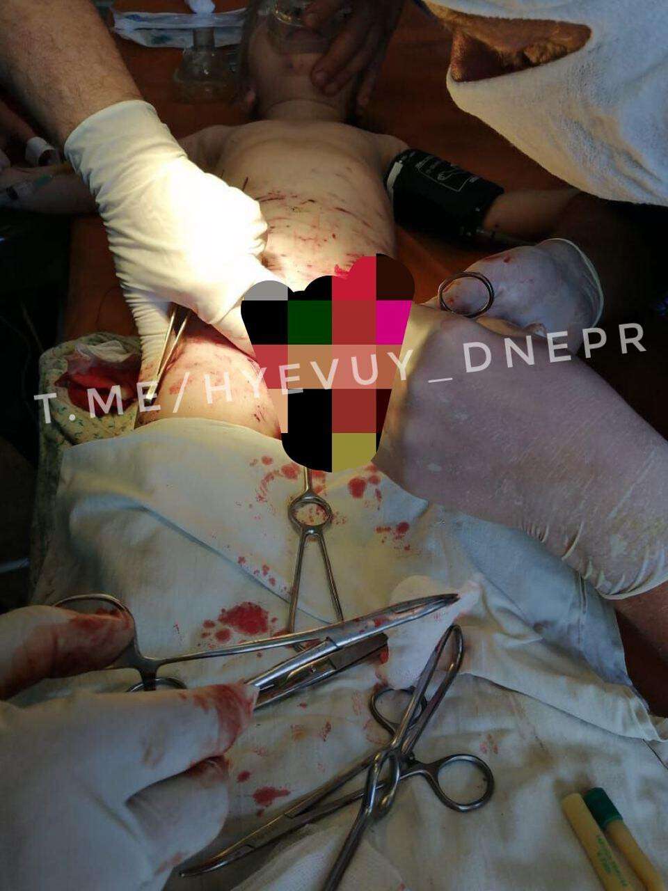 В Днепр привезли ребенка с откушенными гениталиями: фото 18+