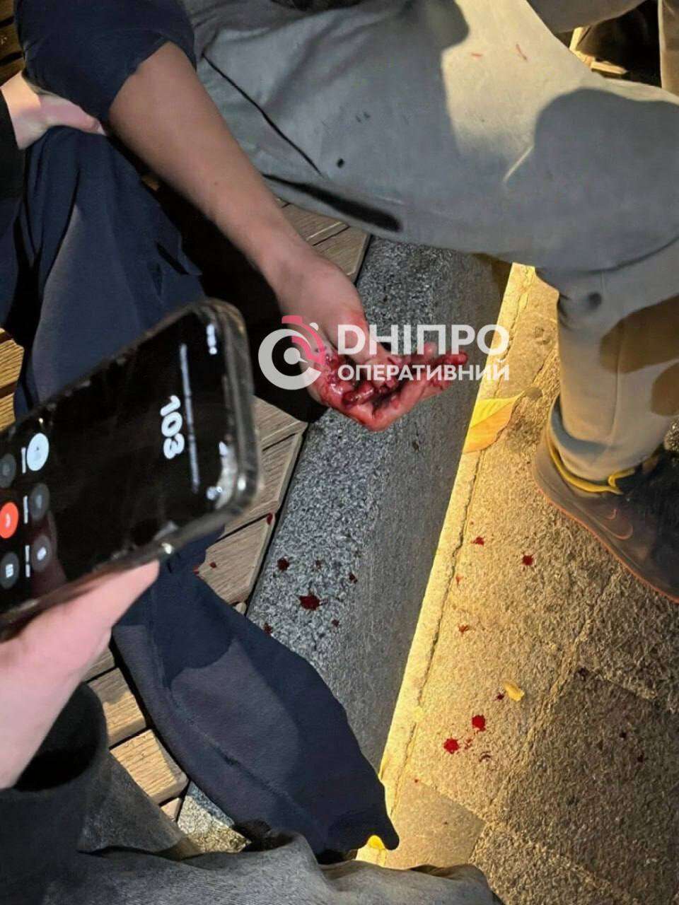 Відірвало палець підлітку