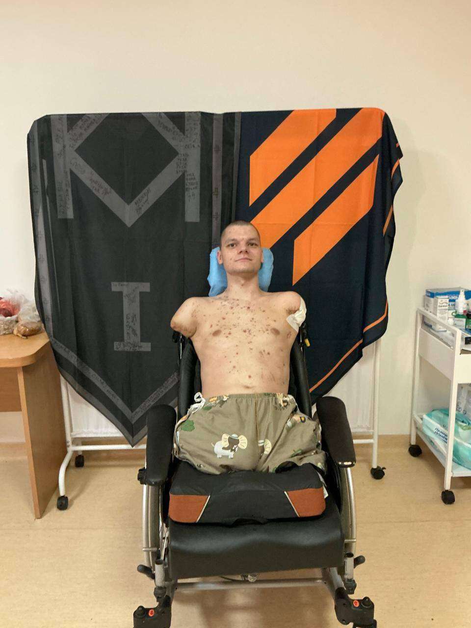 Скандал в ПриватБанке: военный с ампутацией не смог получить карточку из-за отсутствия рук