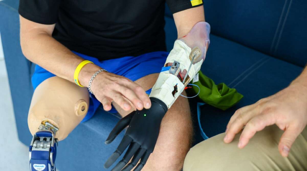 Бионическое протезирование в Украине